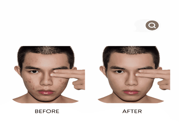 Organic Anti-Acne Three-Step System - Moderate/Severe Acne Prone Skin